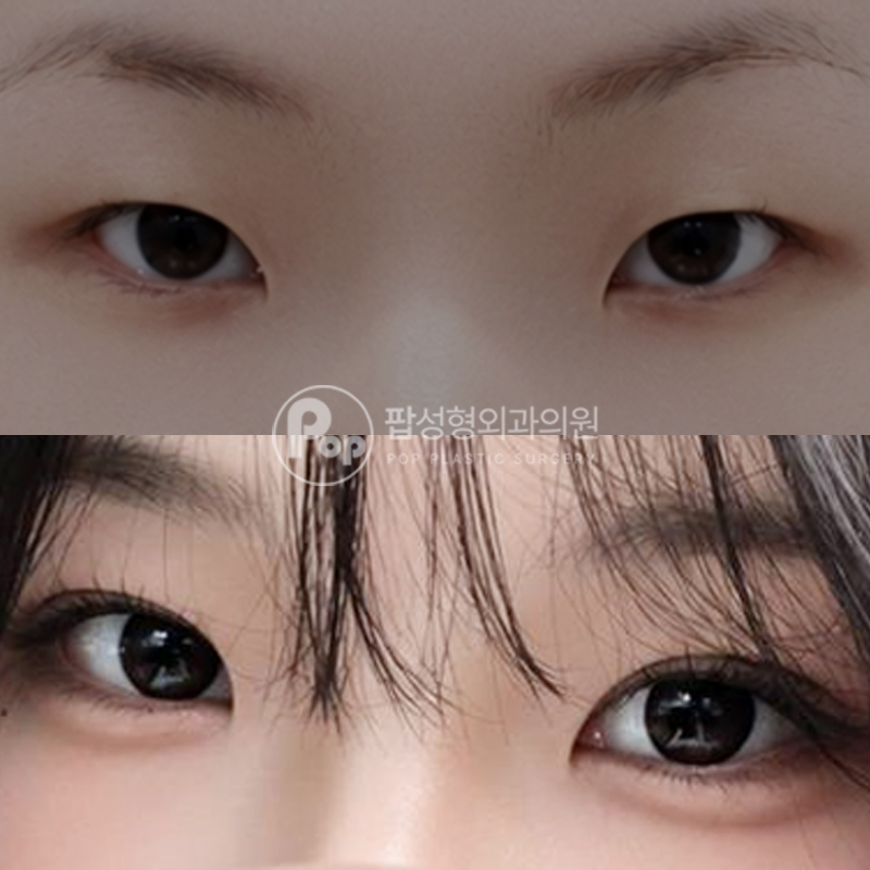 강남 팝성형외과 무쌍에서 인아웃 매몰 쌍수 후기