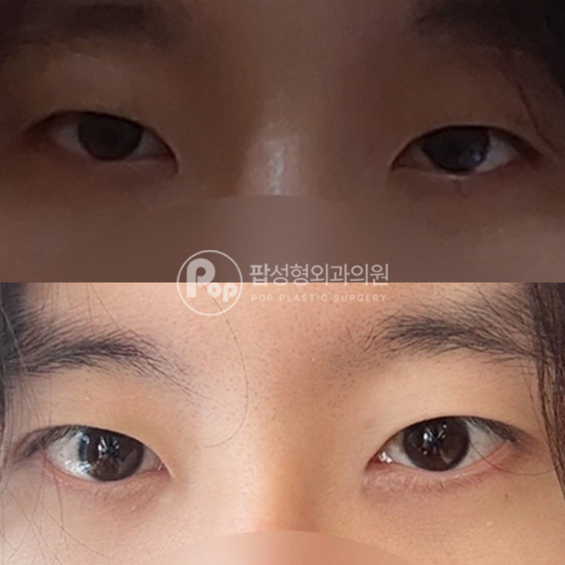 팝성형외과 남자 쌍수 남자 눈매교정 후기