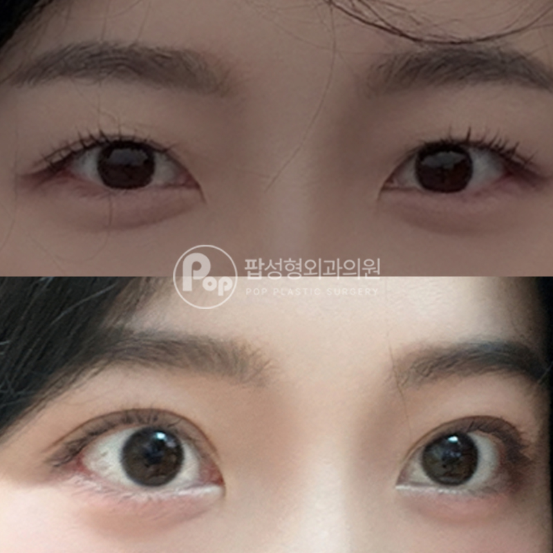 팝성형외과 세미아웃라인 쌍수 눈성형 후기