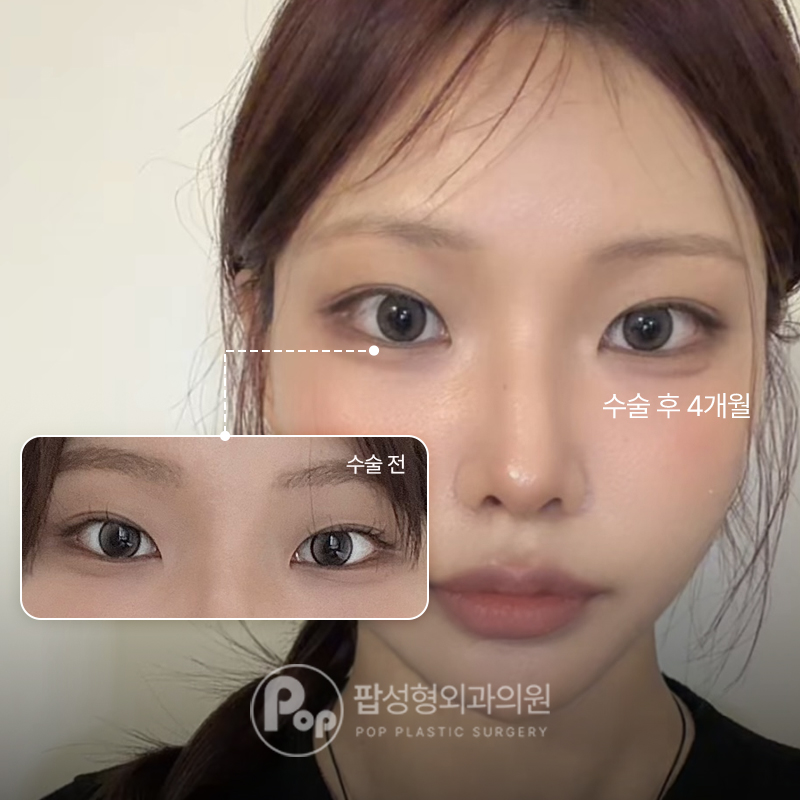 팝성형외과 인아웃 자연유착 트임 눈매교정 후기
