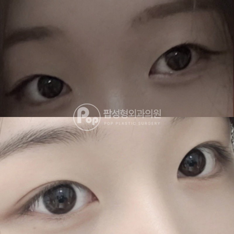 팝성형외과 짝눈 매몰 리뷰