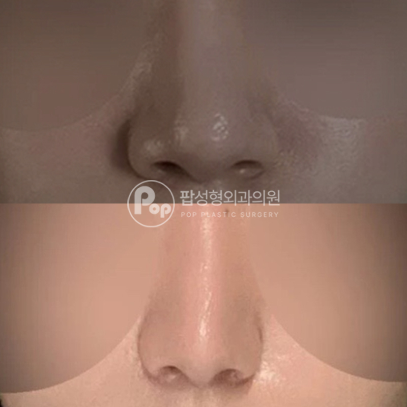 팝성형외과 콧볼축소 후기