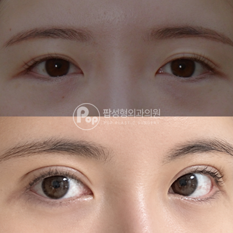 팝성형외과 이마실리프팅 눈재수술 아웃라인 후기