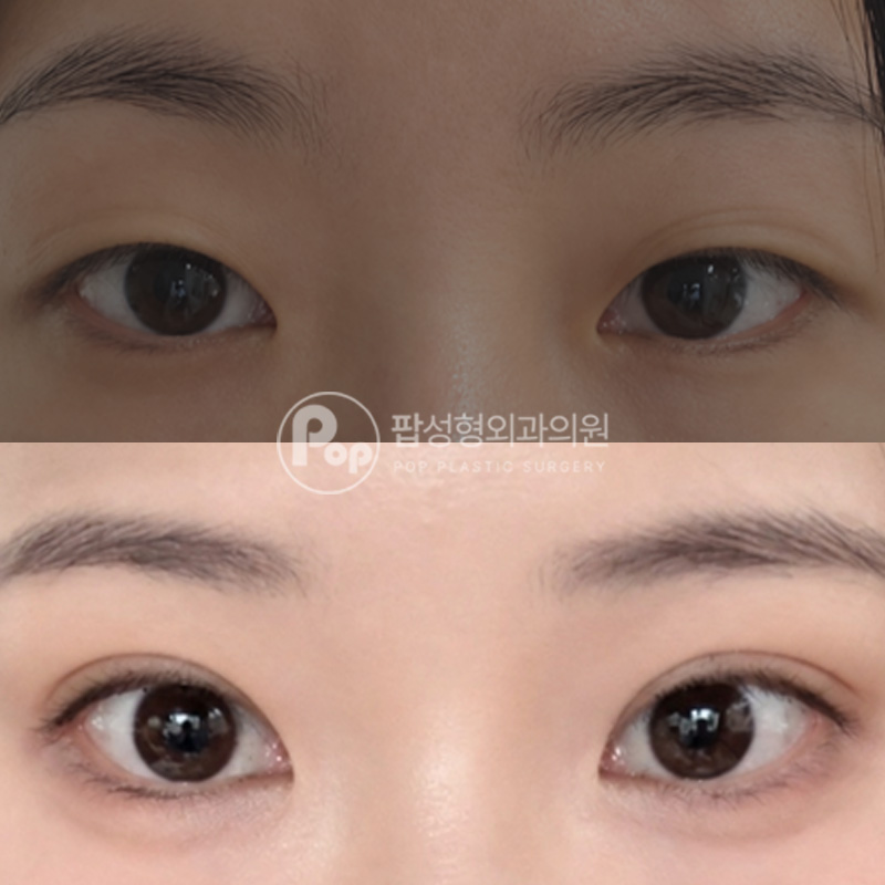 팝성형외과 노화로 인한 눈처짐 쌍커풀