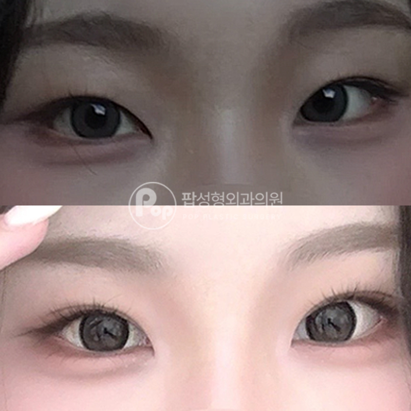 팝성형외과 풀린 라인 자연유착 후기
