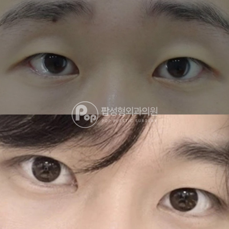 팝성형외과 남자 눈매교정 졸린눈 개선