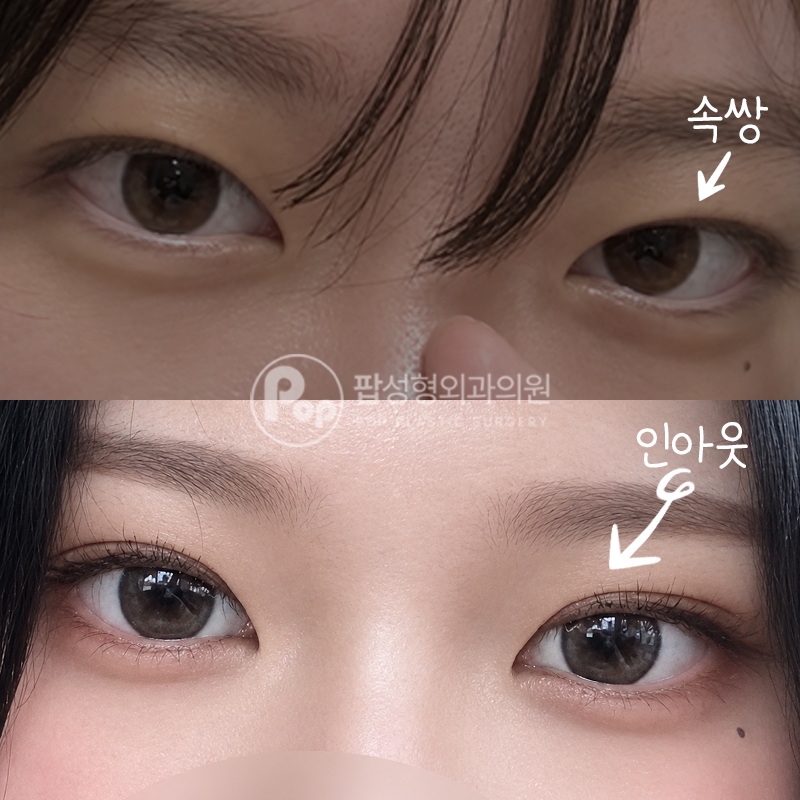 팝성형외과 매몰 눈매교정 윗트임 쌍꺼풀 후기