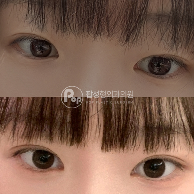 팝성형외과 라인비대칭 짝눈 자연유착 후기