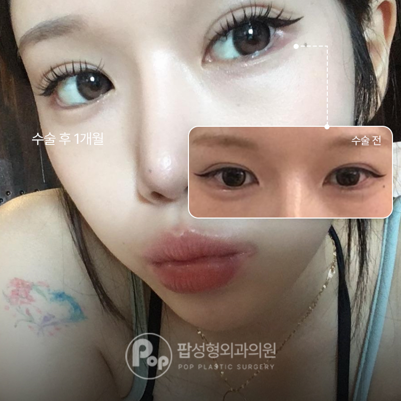 팝성형외과 자연유착+윗트임+뒤밑트임 1개월차 후기