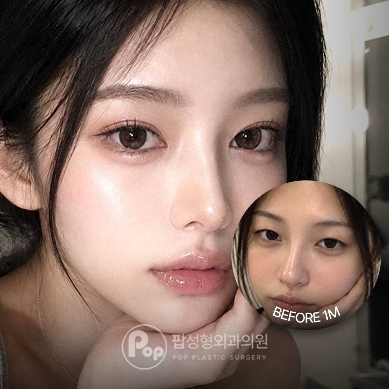 강남 팝성형외과 인아웃라인 자연유착 트임 쌍수 후기