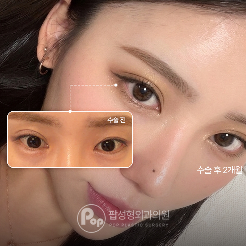 팝성형외과 짝눈에서 세미아웃 절개 눈재수술 후기