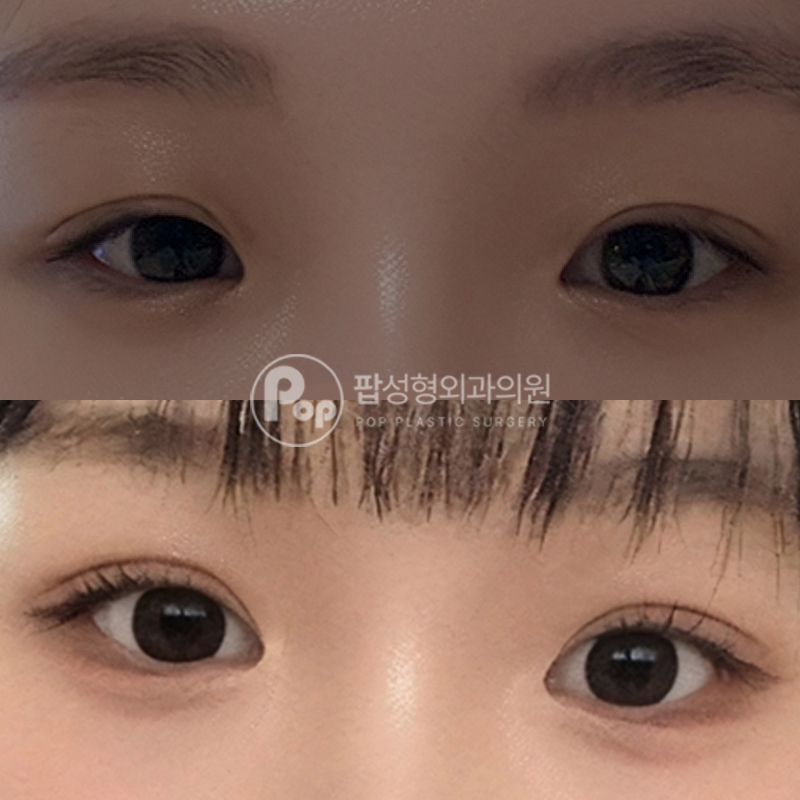 팝성형외과 졸린눈 자연유착 후기