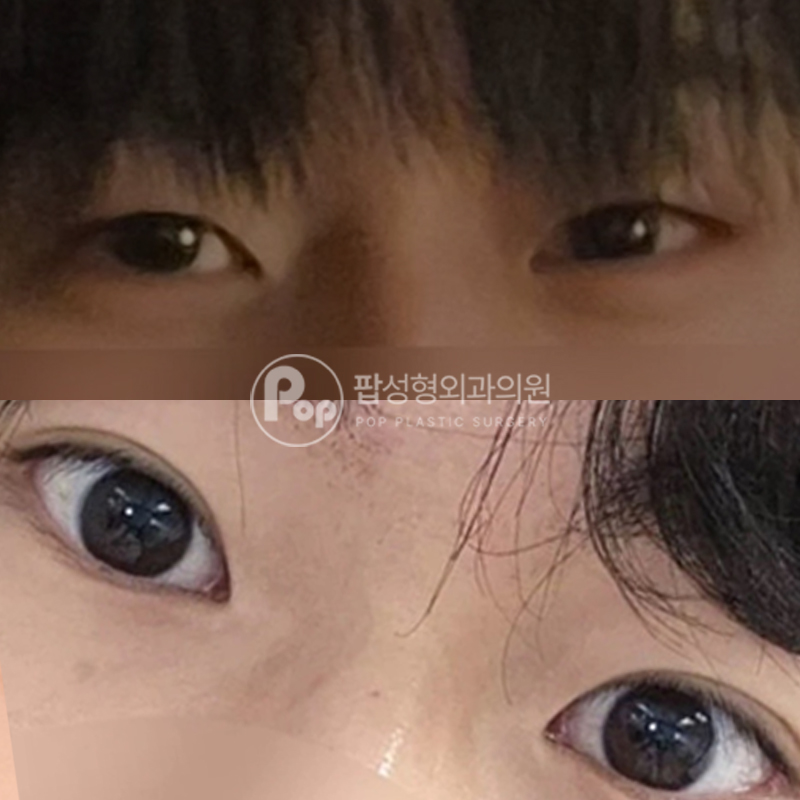 팝성형외과 남자눈성형 눈매교정 쌍수 후기
