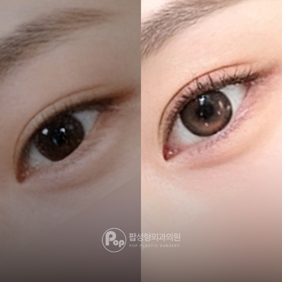팝성형외과 겹쌍 자연유착 매몰 쌍수 리얼 후기