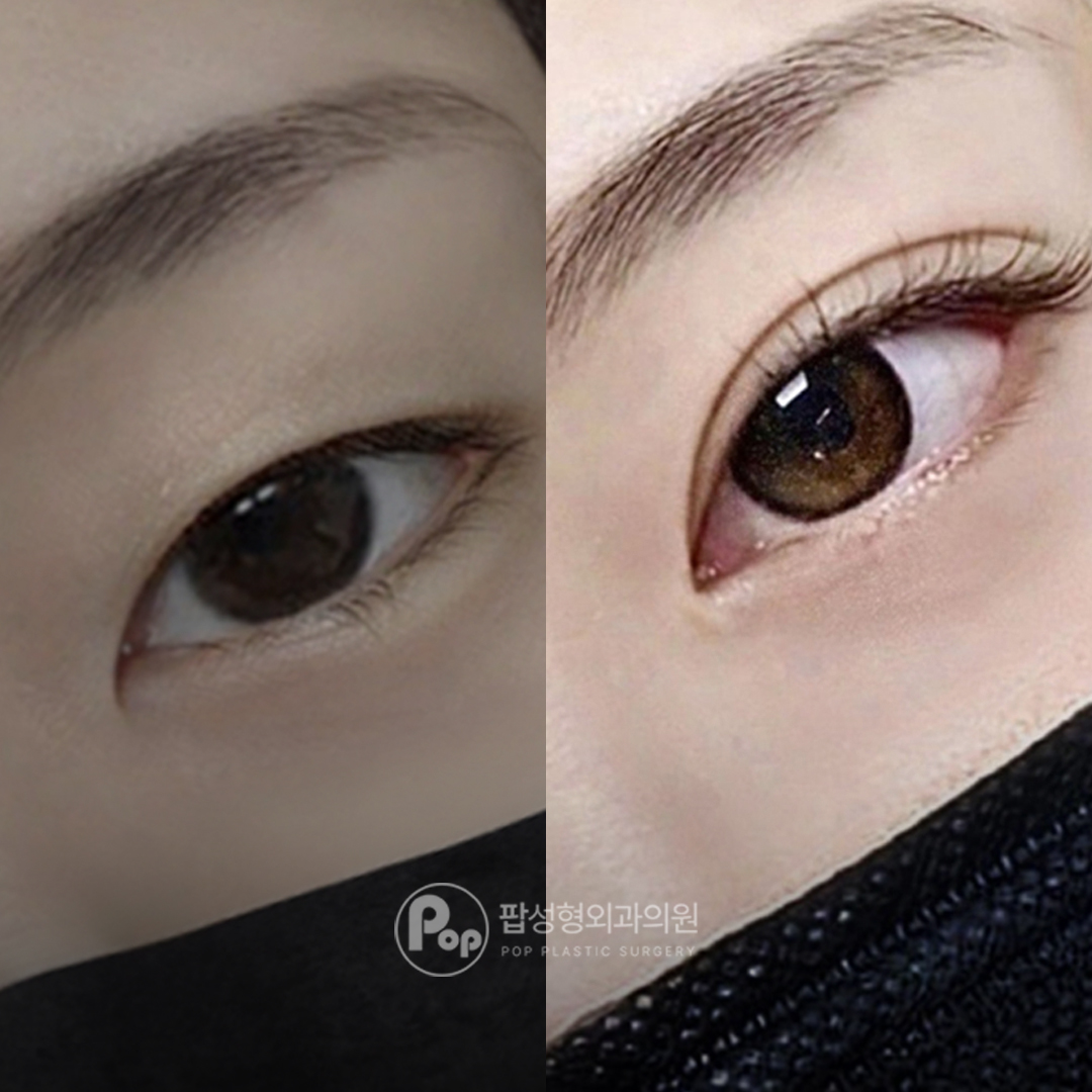 팝성형외과 인아웃라인 사방트임 쌍꺼풀 수술 후기