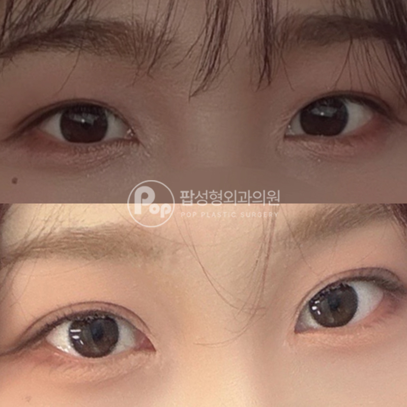 팝성형외과 자연유착 눈재수술 후기