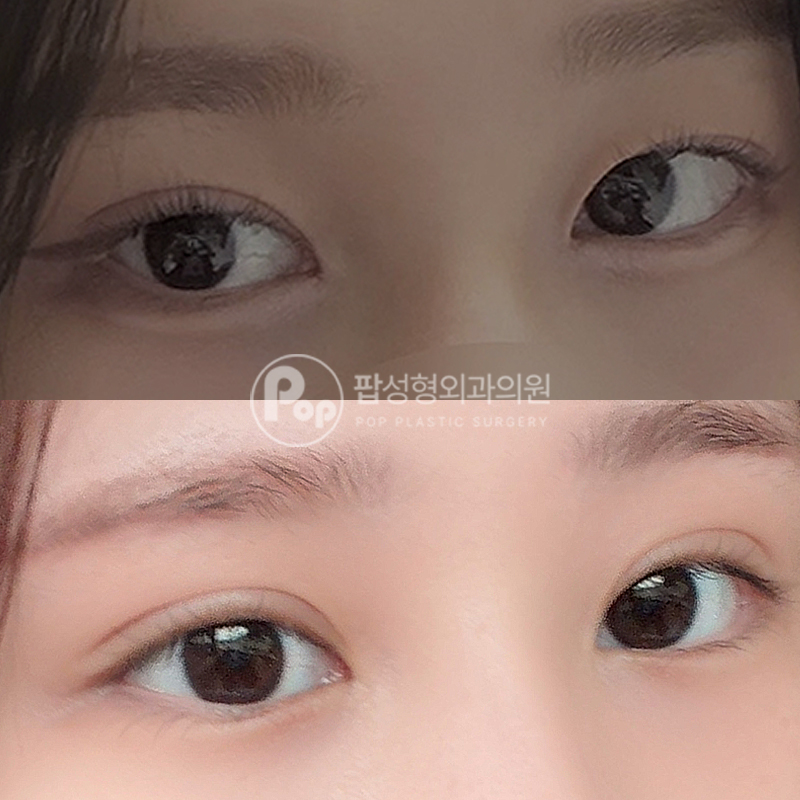 팝성형외과 짝눈 눈재수술 후기