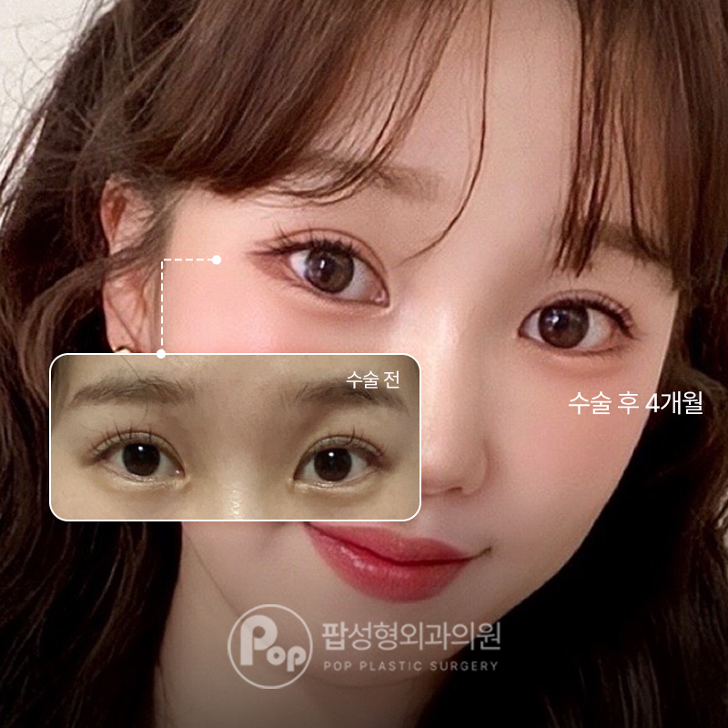 강남 팝성형외과 20대 이마거상 경과별 회복 후기
