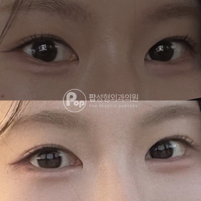 팝성형외과 뒤밑트임 눈성형 후기