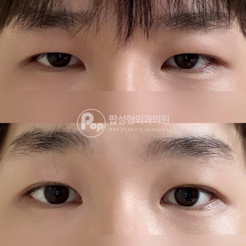 팝성형외과 남자눈 눈매교정 인라인 눈성형 1개월 후기