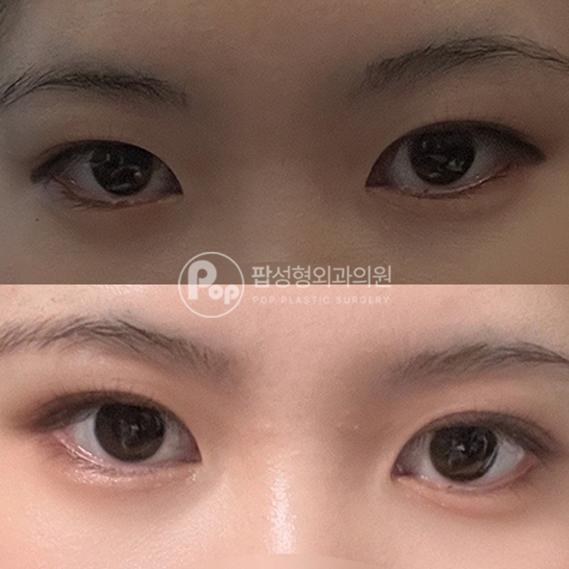 팝성형외과 풀린 라인 자연유착 후기