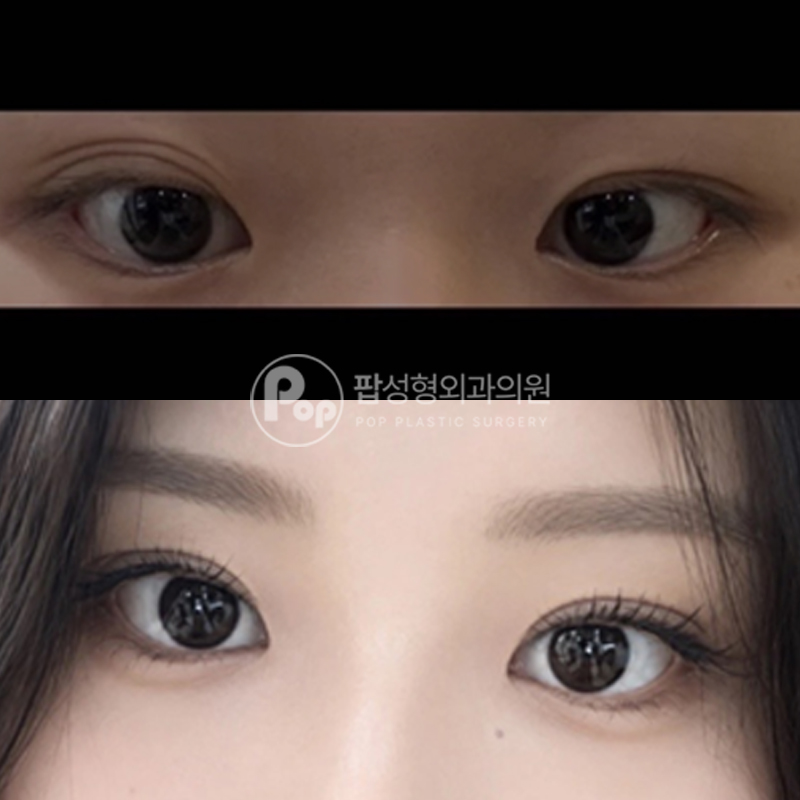 팝성형외과 겹쌍꺼풀 졸린눈 눈재수술 후기