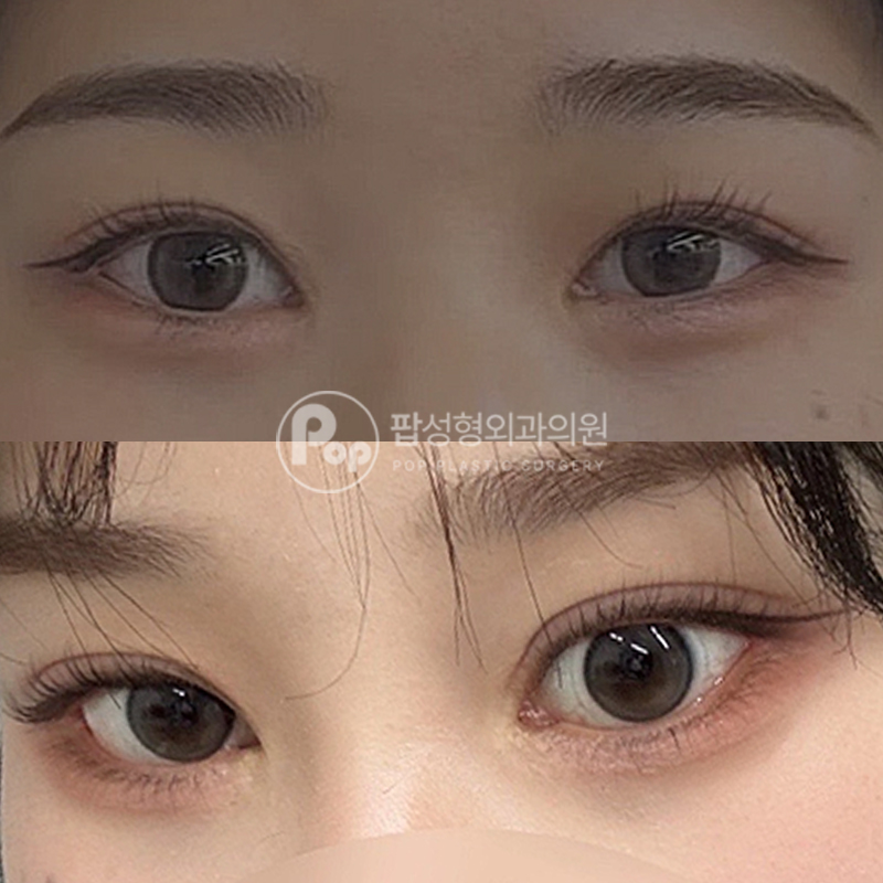 팝성형외과 비대칭라인 눈재수술 후기