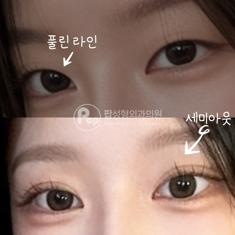 팝성형외과 매몰 눈재수술 세미아웃라인 1년차 후기