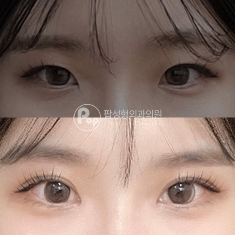 팝성형외과 인아웃 자연유착 쌍수 후기