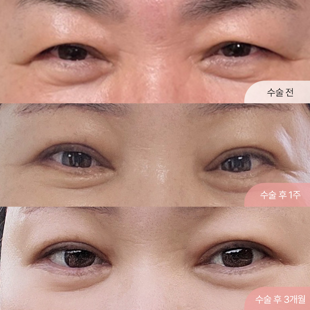 팝성형외과 60대 이마거상 하안검 눈썹거상 경과후기