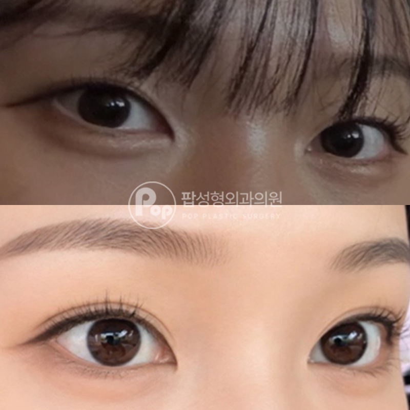 팝성형외과 세미아웃라인 눈재수술 후기