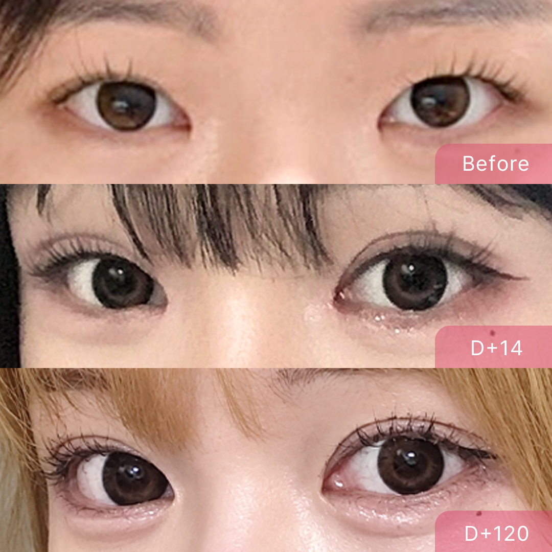 팝성형외과 눈재수술 풀린 라인 개선 매몰 후기