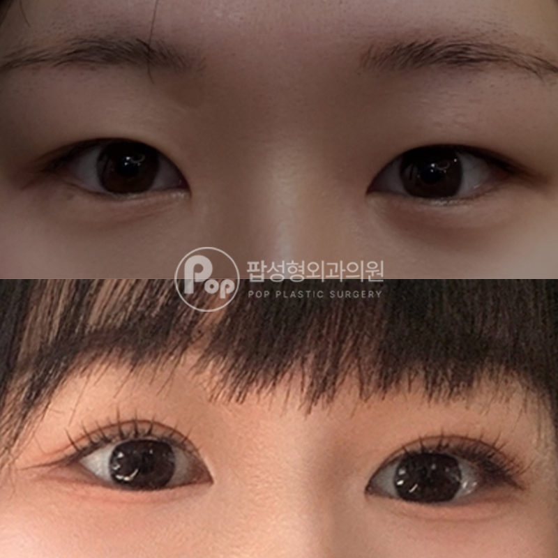 팝성형외과 절개 눈재수술 후기