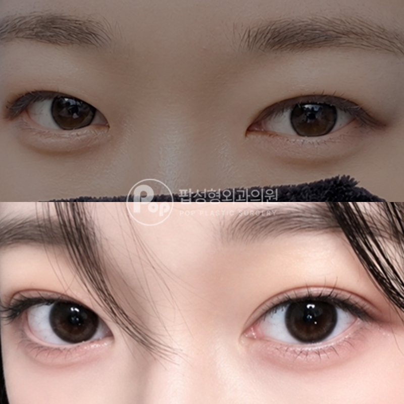 팝성형외과 풀린 라인 매몰 눈재수술 후기