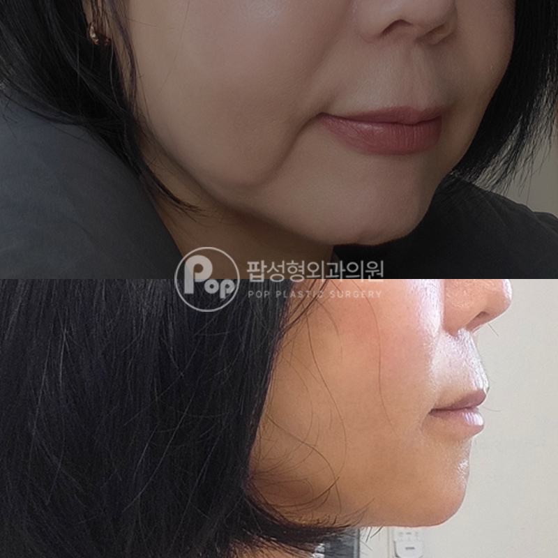 팝성형외과 피부처짐 안면거상 2주차 회복후기