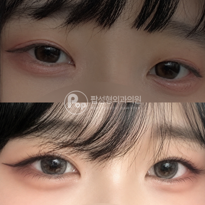 팝성형외과 세미아웃라인 눈성형 후기
