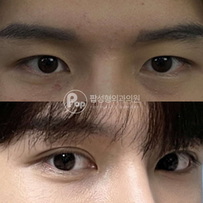 팝성형외과 남자 무쌍 쌍수 후기