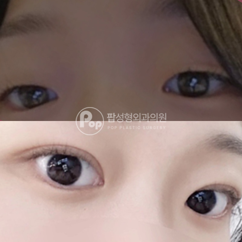팝성형외과 무쌍 인아웃라인 자연유착 후기
