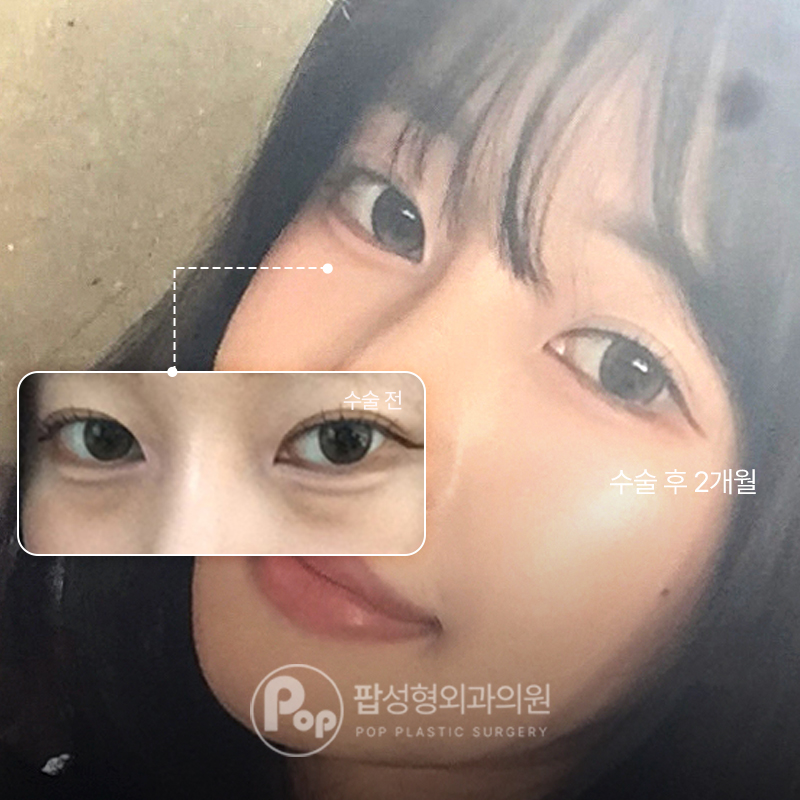 팝성형외과 다크서클 개선 눈밑지방재배치 후기