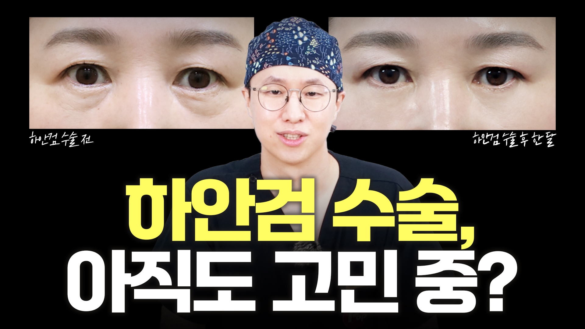 하안검 수술, 아직도 고민 중?