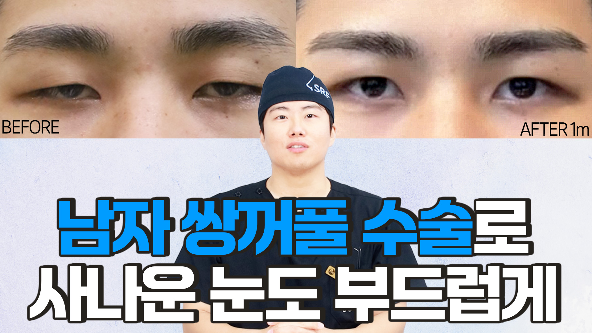 남자 쌍꺼풀 수술