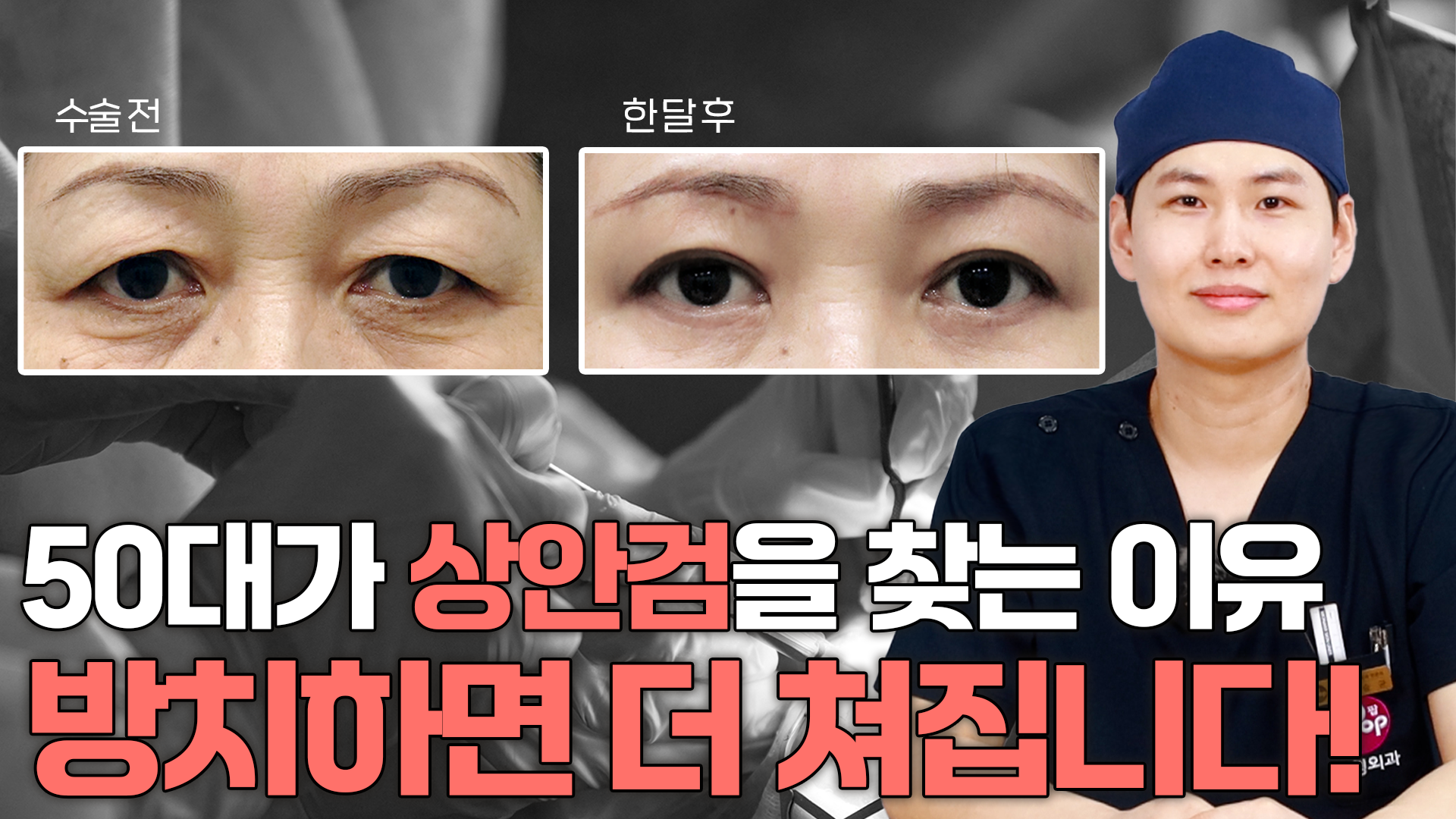 50대가 상안검을 찾는 이유