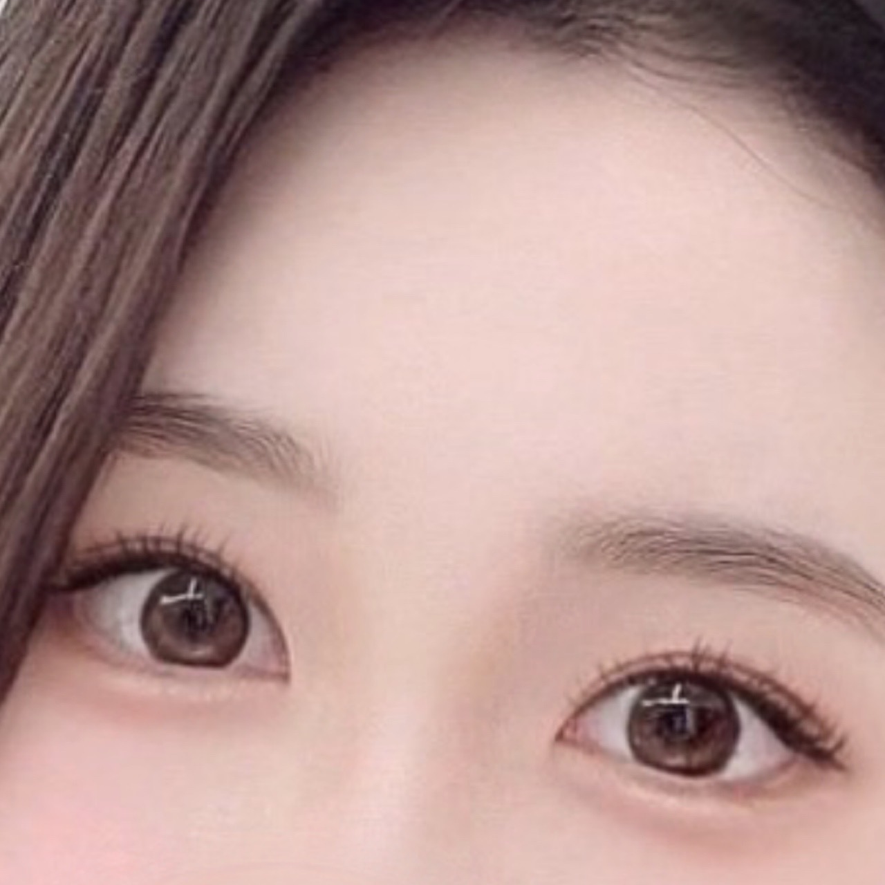 평생자연유착 앞트임 1달차