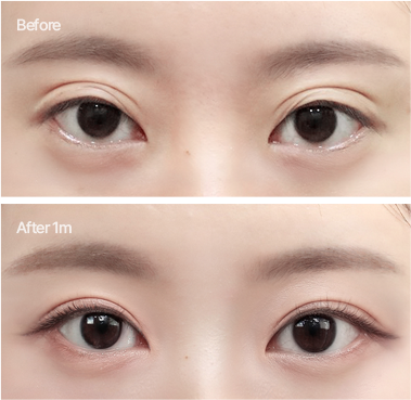 세미아웃라인 수술전후