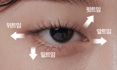 팝성형외과 트임성형