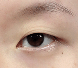안검하수 여부