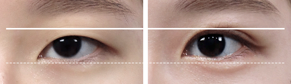 수술전 : 졸려보이는 눈, 수술후 : 또렷해진눈