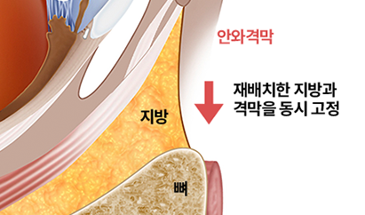 격막강화 눈밑지방재배치