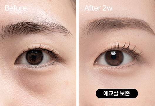 팝 눈밑지방재배치 시술전, 시술 2주후 애교살 보존