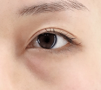 눈밑 지방 진행 1기 (초기)